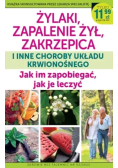 Żylaki zapalenie żył zakrzepica i inne choroby